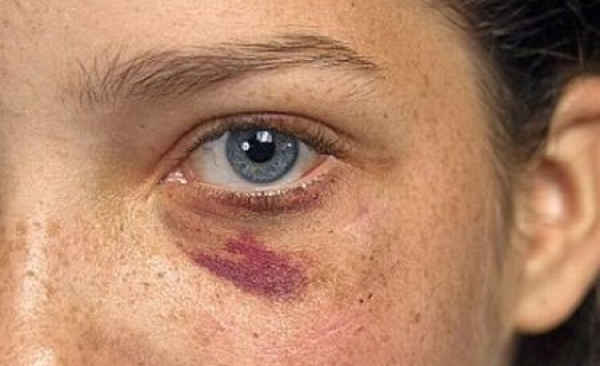 Как в домашних условиях избавиться синяка и ушиба Как в домашних условиях избавиться синяка и ушиба