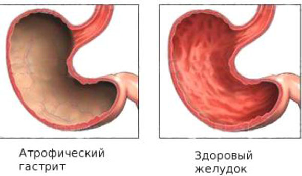 Пародонтит причины симптомы лечение