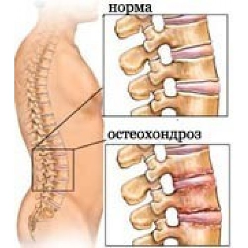 Травы при остеохондрозе шейного отдела