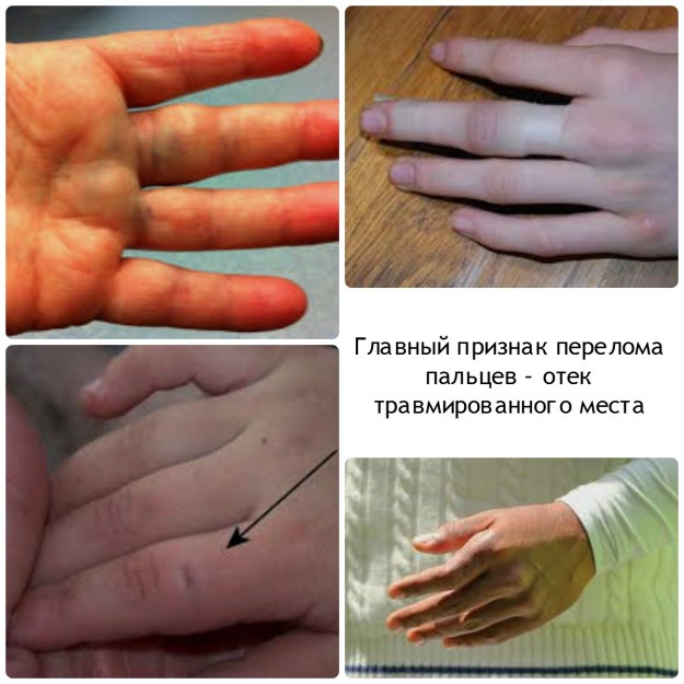 Вертикальная трещина на ногте лечение Вертикальная трещина на ногте лечение