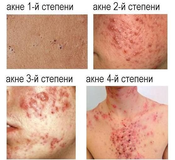 Аллергическая экзема на пальцах рук лечение