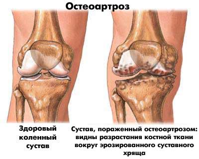 остеоартроз, суставы, спортивная медицина