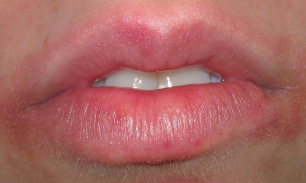 Шелушится кожа лица около рта: причины и лечение