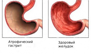 Хронический атрофический гастрит