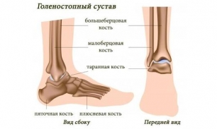 Болит голеностопный сустав утром: причины
