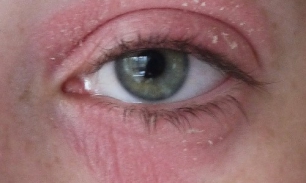 Шелушится кожа вокруг глаз: причины и лечение