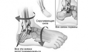 Как лечить боль в щиколотке