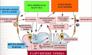 Остеоартрит – одна из причин инвалидности