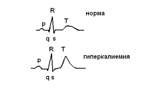 Калий в крови повышен - причины и лечение