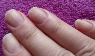 Ребристые ногти: есть ли причина для тревоги