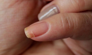 Почему часто ломаются ногти?