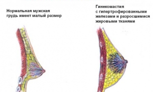 Причины и лечение гинекомастии у мужчин