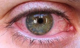 Глазные гельминты: симптомы и лечение