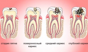 Лечение кариеса по Блэку