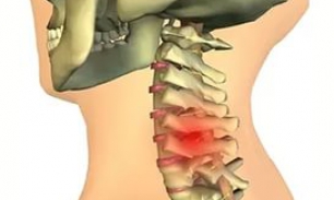 Грыжа в шейном отделе позвоночника: симптомы и лечение