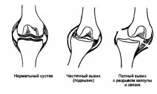 Вывихи: виды, симптомы, лечение