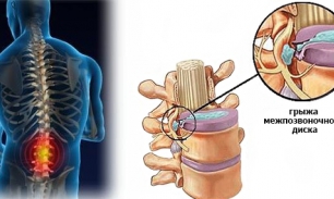 Межпозвоночная грыжа: чем опасна