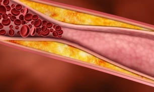 Причины повышенного холестерина в крови