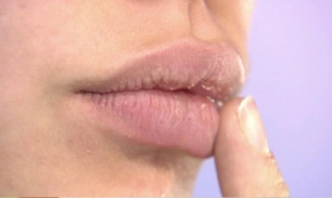 Что делать, если трескаются губы