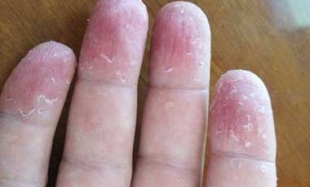 Почему у ребенка облазит кожа на подушечках пальцев и что с этим делать?