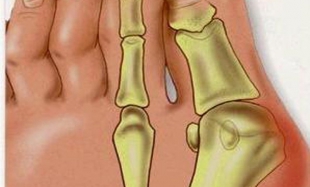 ортопедические стельки при вальгусной деформации стопы