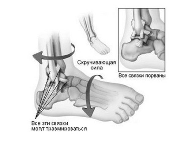 Острая боль в лодыжке при наступлении на ногу без травмы с внешней и внутренней сторон