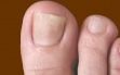 начальная стадия грибка ногтей