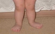 валгусная деформация стопы у детей методы лечения