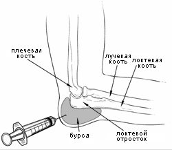 Какой врач лечит локтевые суставы. Бурсит локтевого отростка м70 2. Подкожная синовиальная сумка локтя. Бурситная сумка локтевого сустава. Бурсит локтевого физиотерапия.