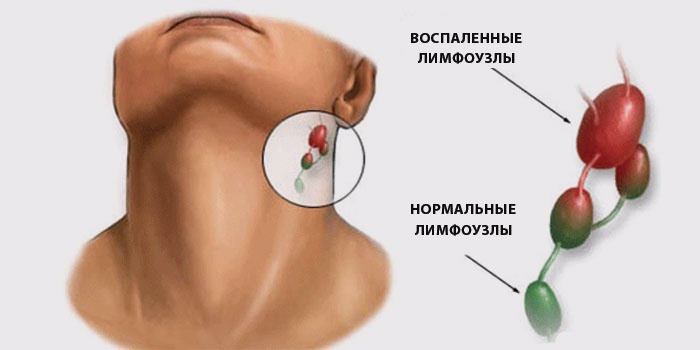 Воспаление лимфоузлов у человека