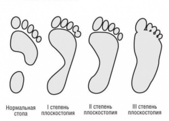 Плоскостопие картинка для детей