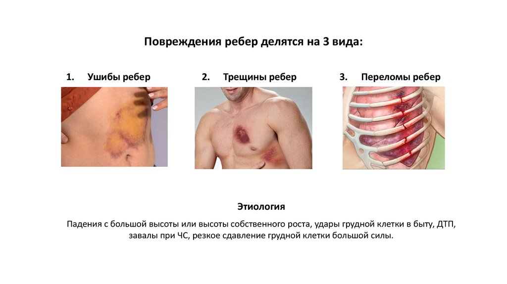 Ушиб ребра в левом боку
