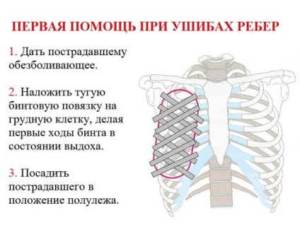 Ушиб ребра в левом боку