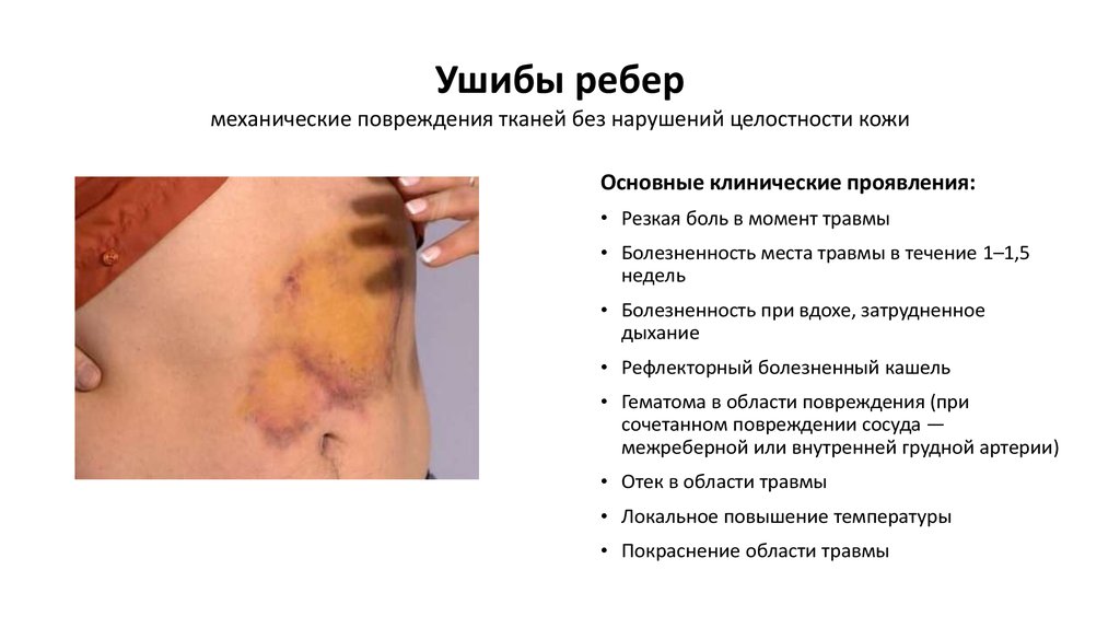 Ушиб ребра в левом боку