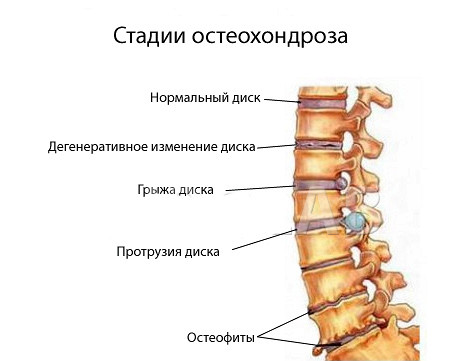 остеохондроз стадии
