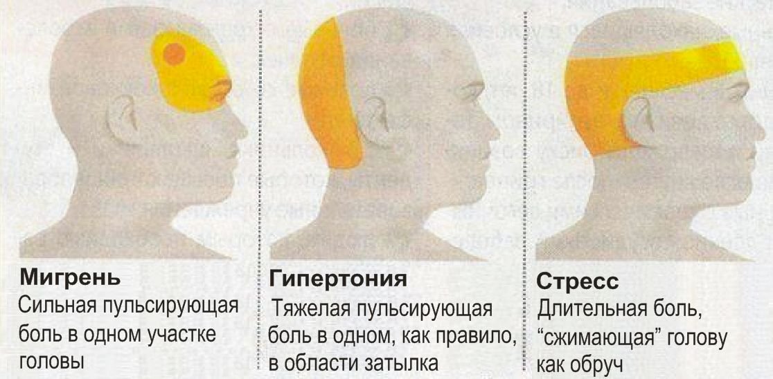 Почему головы желтые. Причины головной боли. Боль в затылке головы причины. Болит голова в затылочной части.