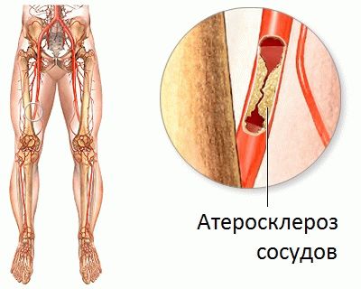 атеросклероз сосудов