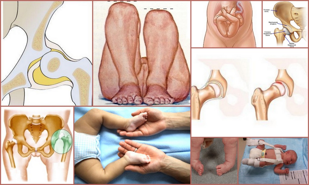 Тазобедренный артрит у ребенка
