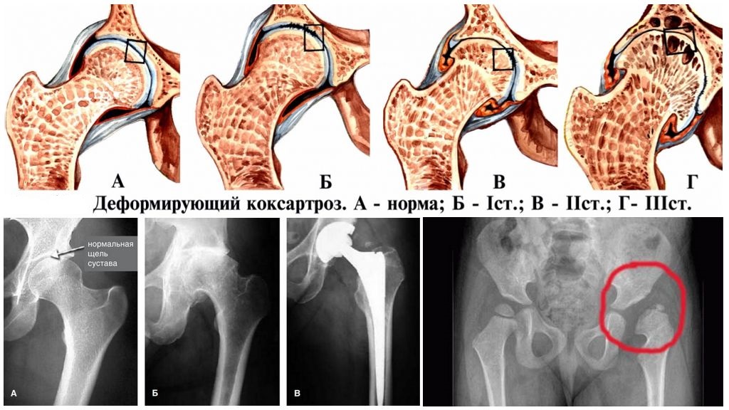 Схема лечения коксартроза